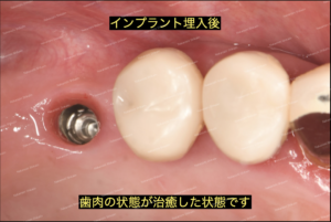 サイナスリフト・骨再生・造成の後は、期間をおいて歯型を取ります